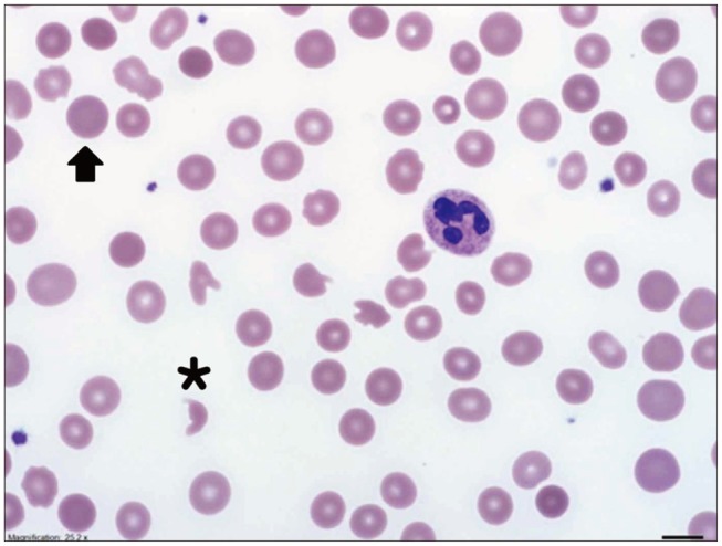 A Case of Microangiopathic Hemolytic Anemia after Myxoma Excision and Mitral Valve Repair Presenting as Hemolytic Uremic Syndrome.