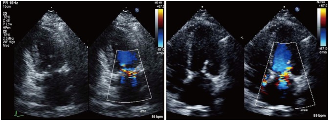 A Case of Microangiopathic Hemolytic Anemia after Myxoma Excision and Mitral Valve Repair Presenting as Hemolytic Uremic Syndrome.