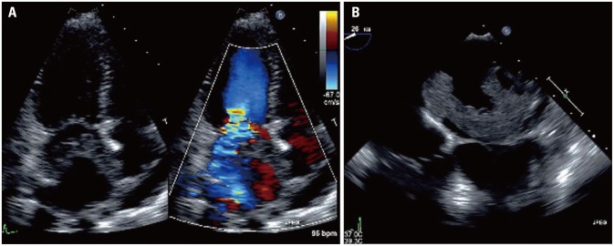 A Case of Microangiopathic Hemolytic Anemia after Myxoma Excision and Mitral Valve Repair Presenting as Hemolytic Uremic Syndrome.