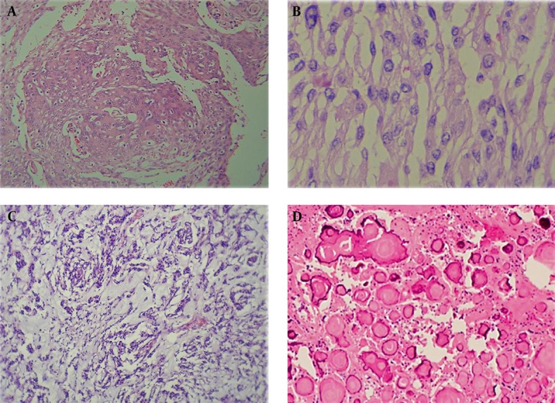 Does Histologic Subtype Influence the Post-Operative Outcome in Spinal Meningioma?