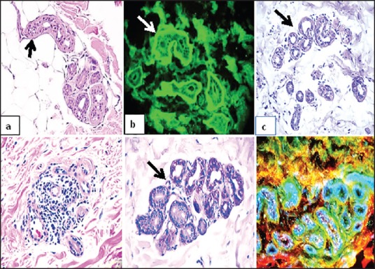 Periodic Acid-Schiff Staining Parallels the Immunoreactivity Seen By Direct Immunofluorescence in Autoimmune Skin Diseases.