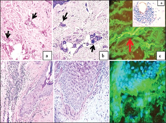 Periodic Acid-Schiff Staining Parallels the Immunoreactivity Seen By Direct Immunofluorescence in Autoimmune Skin Diseases.