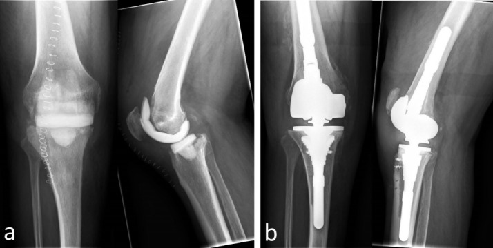 Outcome of total knee replacement following explantation and cemented spacer therapy.