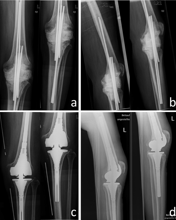 Outcome of total knee replacement following explantation and cemented spacer therapy.