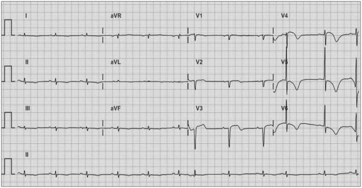 Response to Letter Regarding Article, "Biventricular Takotsubo Cardiomyopathy Associated with Epilepsy".