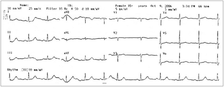 Response to Letter Regarding Article, "Biventricular Takotsubo Cardiomyopathy Associated with Epilepsy".