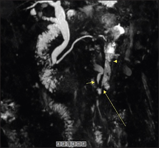 Pancreaticoureteral Fistula: A Rare Complication of Chronic Pancreatitis.