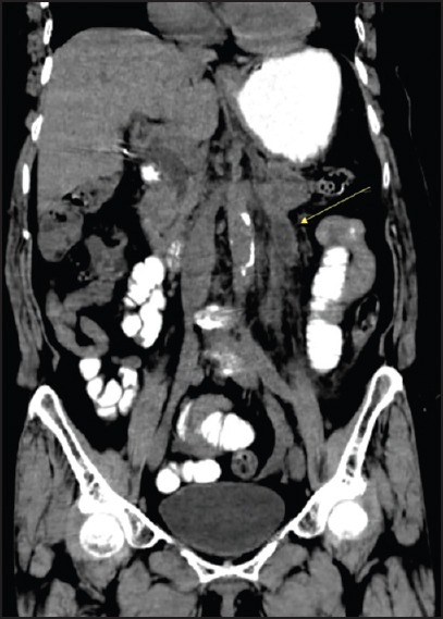 Pancreaticoureteral Fistula: A Rare Complication of Chronic Pancreatitis.