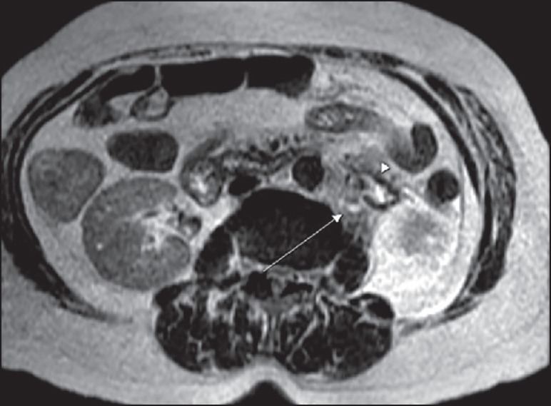 Pancreaticoureteral Fistula: A Rare Complication of Chronic Pancreatitis.