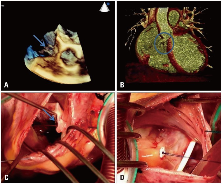 Rupture of Right Sinus of Valsalva Aneurysm into Right Cardiac Chambers: The Role of Different Imaging Modalities.