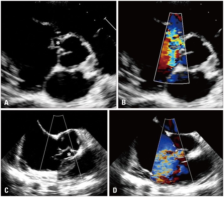 Rupture of Right Sinus of Valsalva Aneurysm into Right Cardiac Chambers: The Role of Different Imaging Modalities.