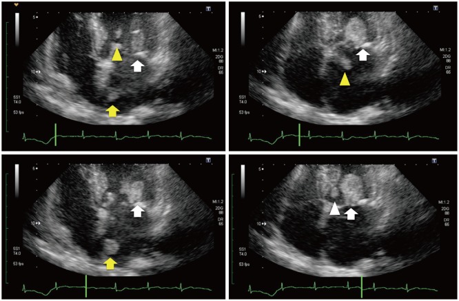 Primary Multiple Cardiac Myxomas in a Patient without the Carney Complex.