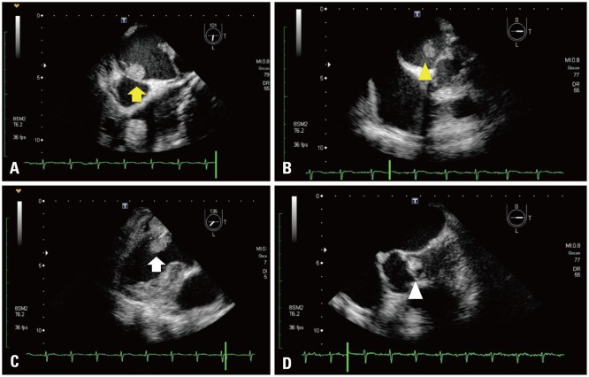 Primary Multiple Cardiac Myxomas in a Patient without the Carney Complex.