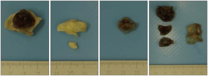 Primary Multiple Cardiac Myxomas in a Patient without the Carney Complex.