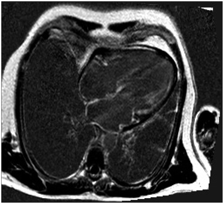 Abnormal Myocardial Blood Flow Reserve Observed in Cardiac Amyloidosis.