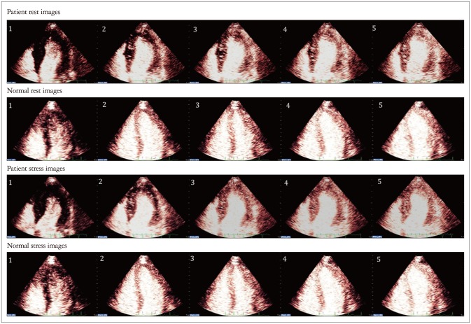 Abnormal Myocardial Blood Flow Reserve Observed in Cardiac Amyloidosis.