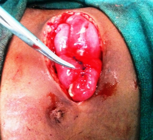 Low Voltage Electric Current Causing Ileal Perforation: A Rare Injury.