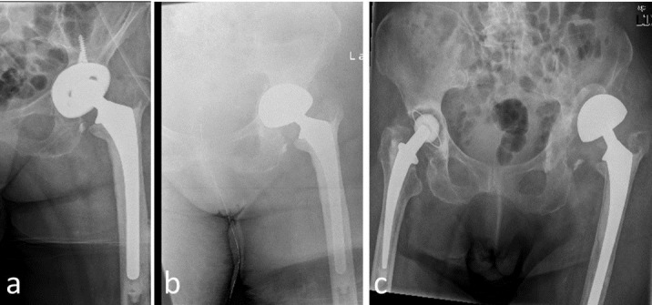 Bipolar hip arthroplasty as salvage treatment for loosening of the acetabular cup with significant bone defects.