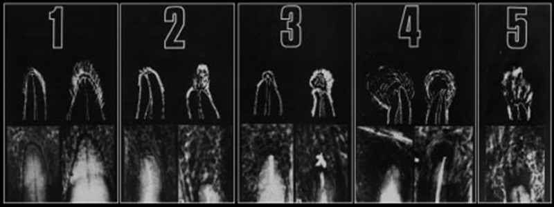 Radiographic evaluation of periapical status and frequency of endodontic treatment in a turkish population: a retrospective study.