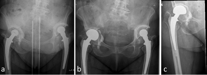 Bipolar hip arthroplasty as salvage treatment for loosening of the acetabular cup with significant bone defects.