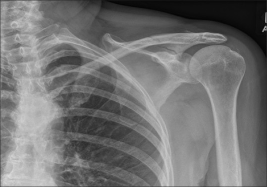 Case report of bisphosphonate-associated atypical scapular fracture and brief literature review.