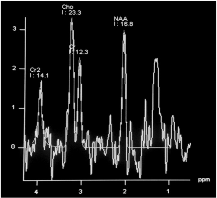 Magnetic resonance spectroscopy — Revisiting the biochemical and molecular milieu of brain tumors