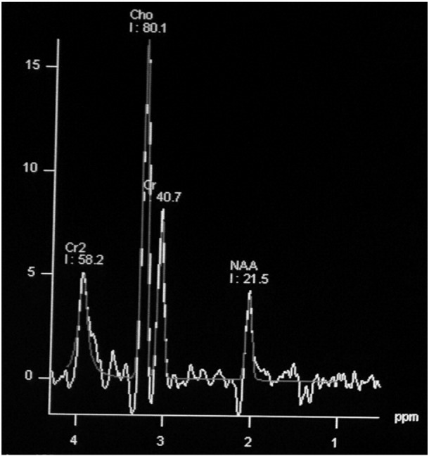 Magnetic resonance spectroscopy — Revisiting the biochemical and molecular milieu of brain tumors