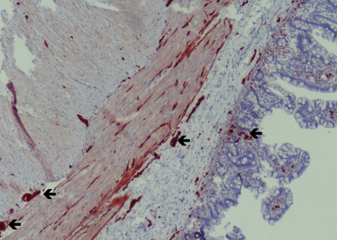 Fetal Bowel Dilatation due to Intestinal Neuronal Dysplasia: A Rarity.