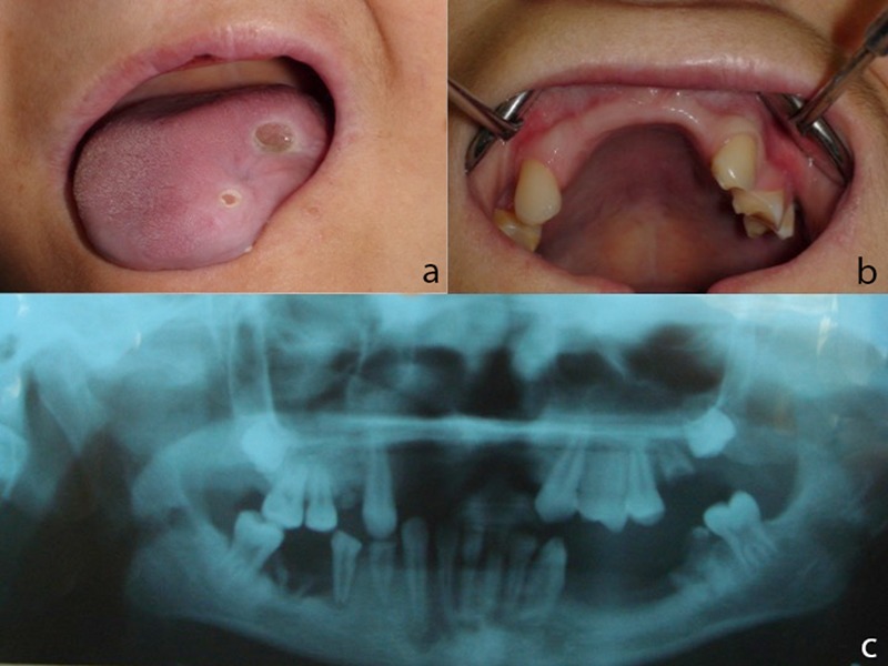 Oral manifestations and prosthetic rehabilitation in hereditary sensory and autonomic neuropathy (HSAN)type IV: a case report.