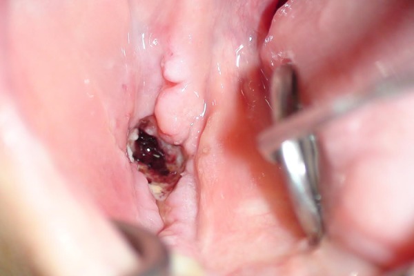 Oral manifestations and prosthetic rehabilitation in hereditary sensory and autonomic neuropathy (HSAN)type IV: a case report.