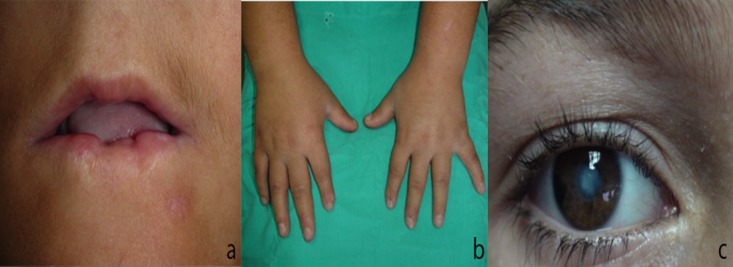 Oral manifestations and prosthetic rehabilitation in hereditary sensory and autonomic neuropathy (HSAN)type IV: a case report.