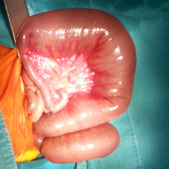 Fetal Bowel Dilatation due to Intestinal Neuronal Dysplasia: A Rarity.
