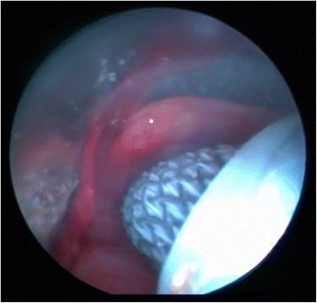 Placement of self-expandable bifurcated metallic stents without use of fluoroscopic and guidewire guidance to palliate central airway lesions.