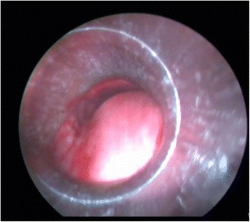 Placement of self-expandable bifurcated metallic stents without use of fluoroscopic and guidewire guidance to palliate central airway lesions.