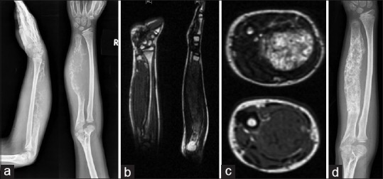 Reconstruction of the elbow and forearm for Ewing sarcoma of ulna: A new biological technique.