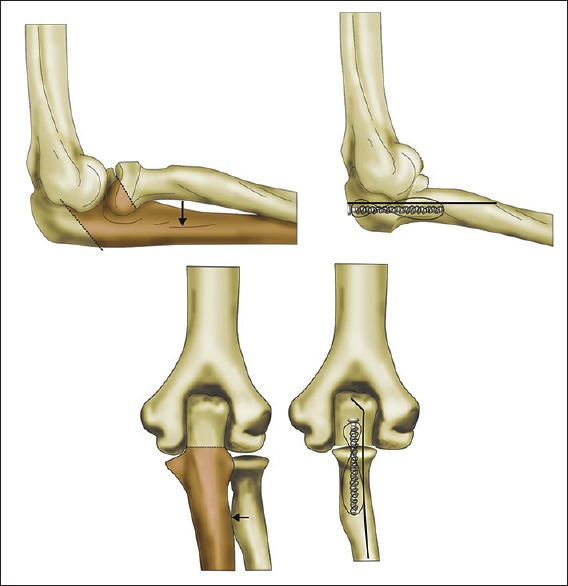 Reconstruction of the elbow and forearm for Ewing sarcoma of ulna: A new biological technique.