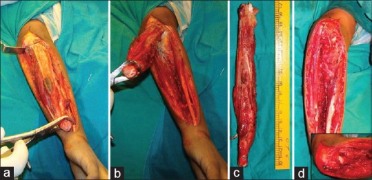 Reconstruction of the elbow and forearm for Ewing sarcoma of ulna: A new biological technique.