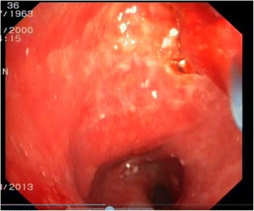 Tracheobronchopathia Osteochondroplastica: a rare case report of a non-smoker and non-atopic patient, with a long history of wheezing since childhood.