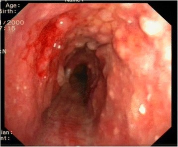 Tracheobronchopathia Osteochondroplastica: a rare case report of a non-smoker and non-atopic patient, with a long history of wheezing since childhood.