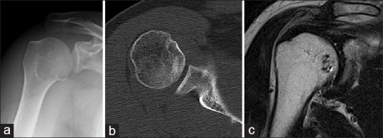 Osteochondritis dissecans on the medial aspect of the humeral head.