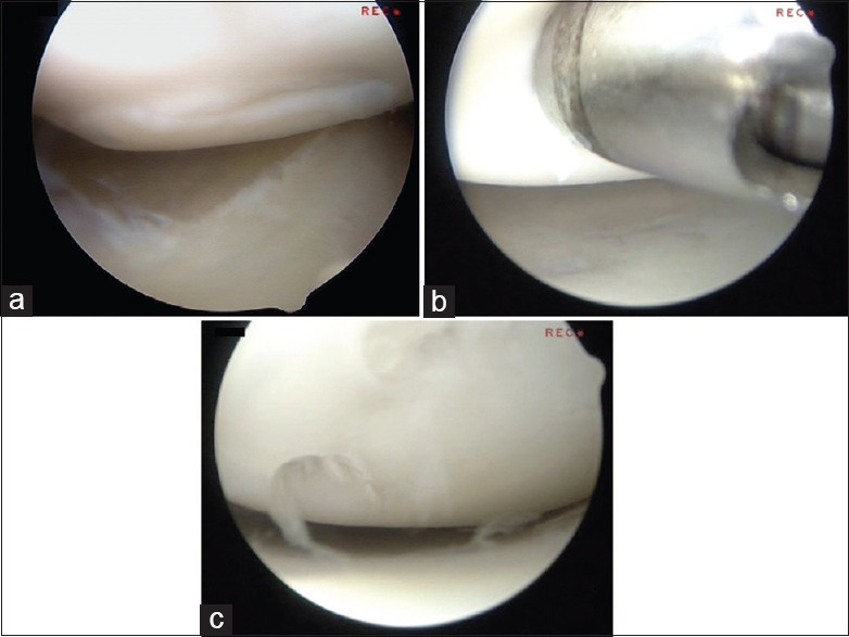 Osteochondritis dissecans on the medial aspect of the humeral head.