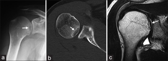 Osteochondritis dissecans on the medial aspect of the humeral head.