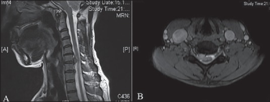 Cervical disc hernia operations through posterior laminoforaminotomy.