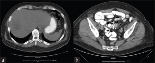 Fusobacterium Nucleatum: Atypical Organism of Pyogenic Liver Abscess Might be Related to Sigmoid Diverticulitis.