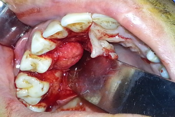 Peripheral osteoma of the hard palate: a rare case report and literature review.