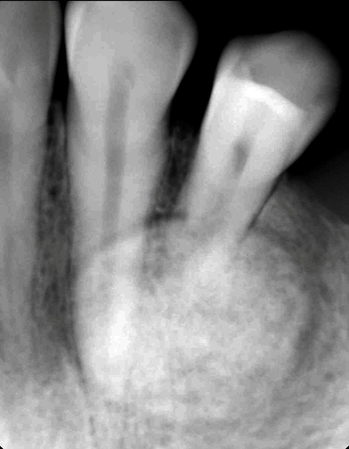 Peripheral osteoma of the hard palate: a rare case report and literature review.