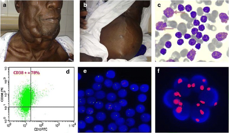 Characteristics of chronic lymphocytic leukemia in Senegal.