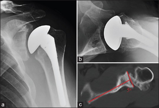 Observation of initial postoperative radiolucent lines using a modern pegged-glenoid design.