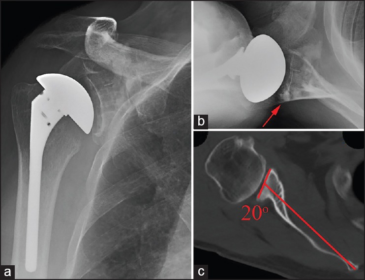 Observation of initial postoperative radiolucent lines using a modern pegged-glenoid design.