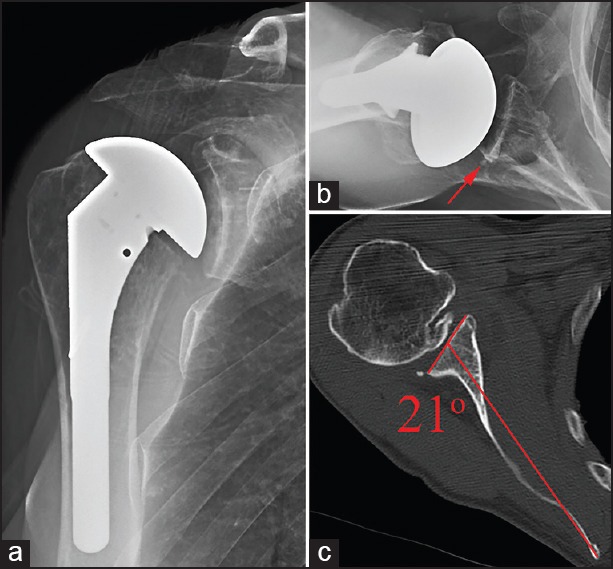 Observation of initial postoperative radiolucent lines using a modern pegged-glenoid design.